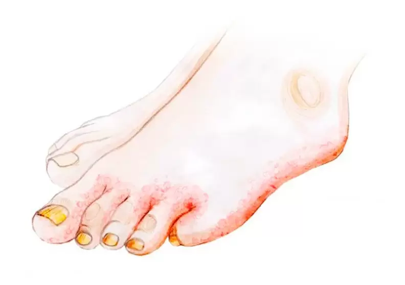 Fungus on toes and how to use Zenidol cream