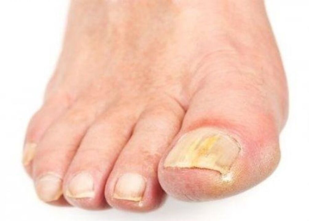 yellowing nails with fungus