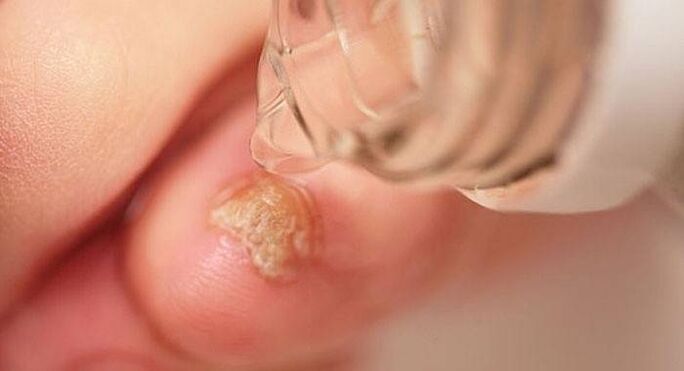 Drips from fungus on toenails