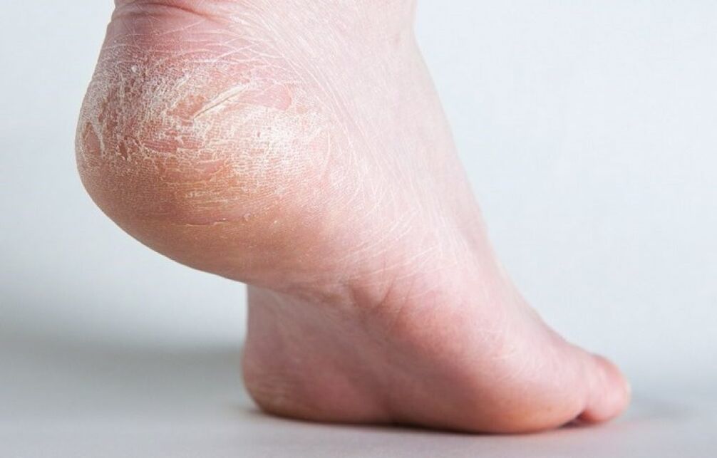 How to treat skin fungus on legs