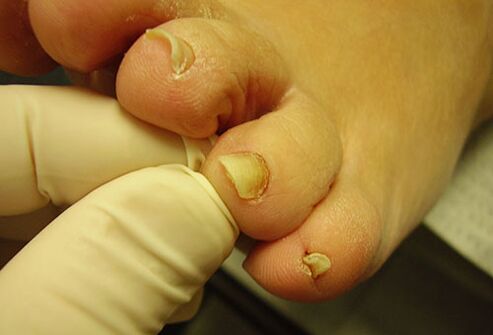 yellow toenail with fungus