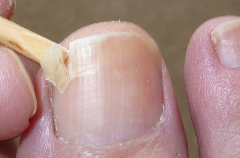 Damaged nails a risk factor for fungal infection