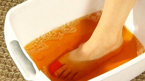 Iodine bath to prevent foot fungus