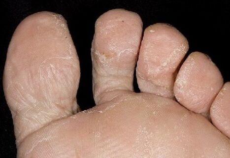 The initial stage of fungus, between fingers