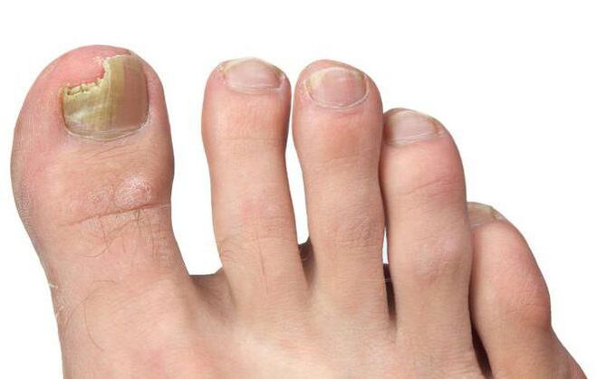 Fungus on the toe