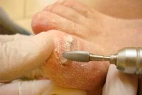 Mechanical cutting of fingernails