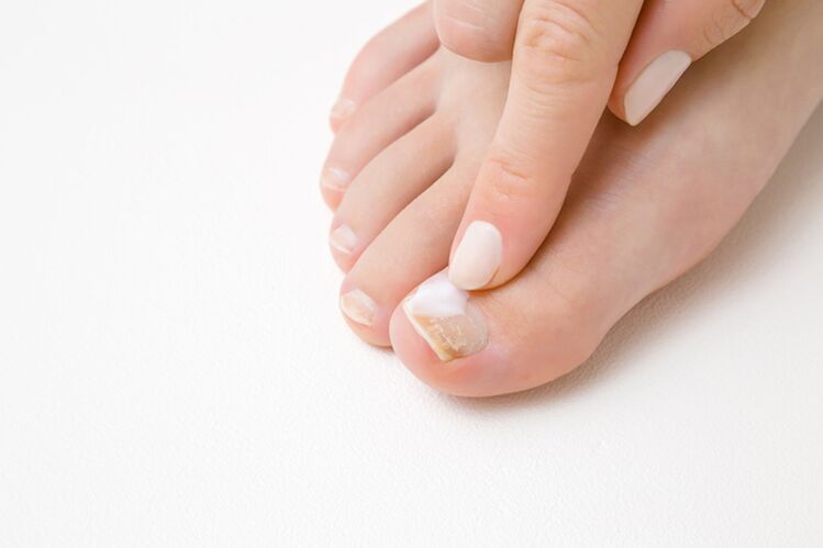 Fungus ointment to treat fingers