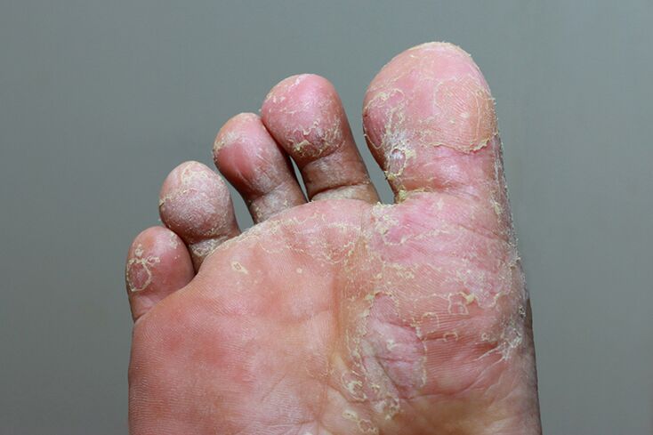 Severe finger skin lesions