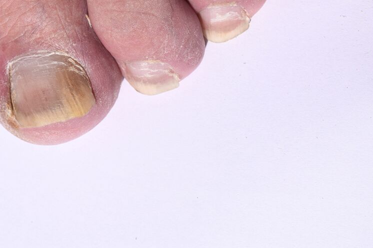 The initial stage of nails on the legs