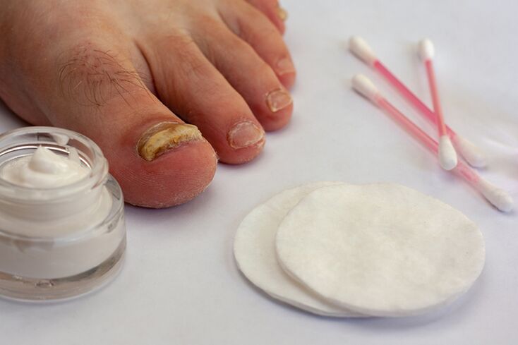 Treat finger fungus with fungal cream