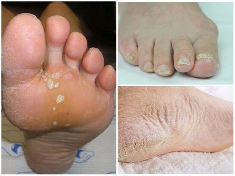 Symptoms of fungi