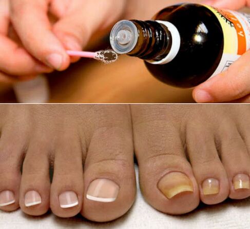 Iodine fights fungi