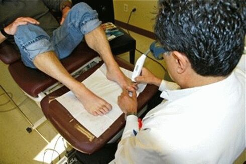 Laser onychomycosis removal