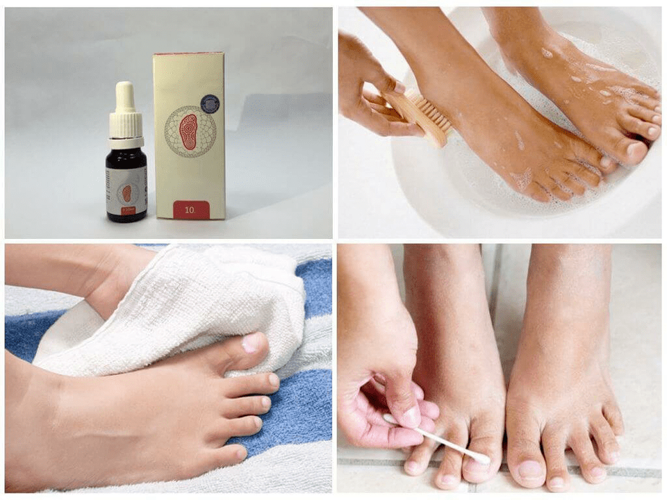 Various treatments for foot fungus