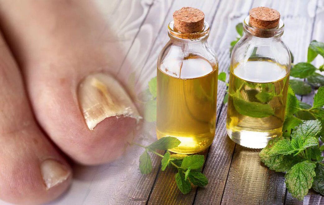 Vinegar treatment for onychomycosis