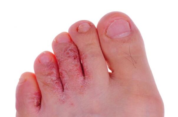Toe fungus