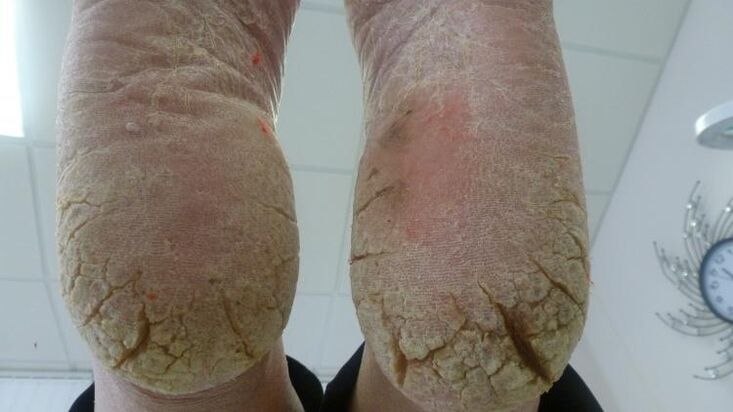 Symptoms of fungus on feet