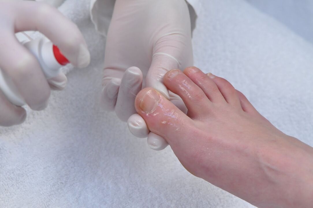 Treat toenail fungus
