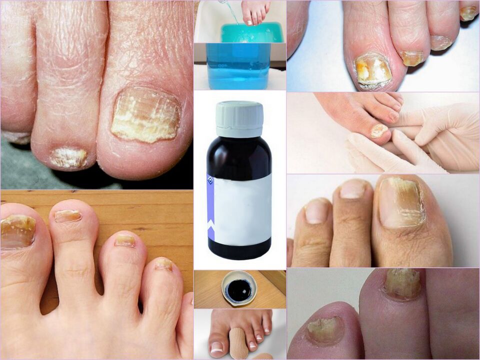 Medications to Treat Toenail Fungus