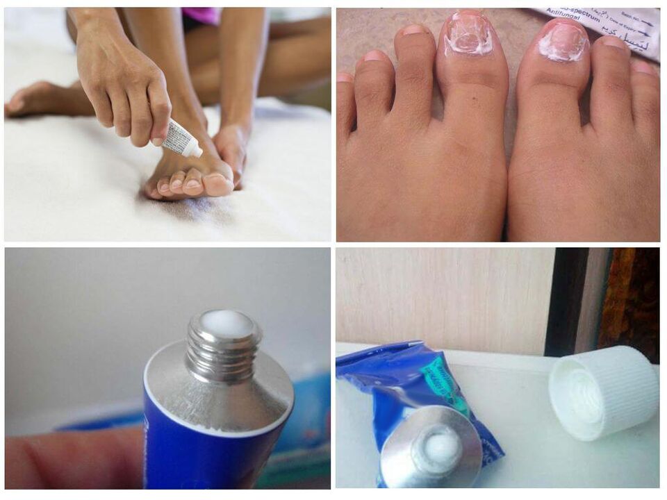 Medicinal preparations effective against onychomycosis