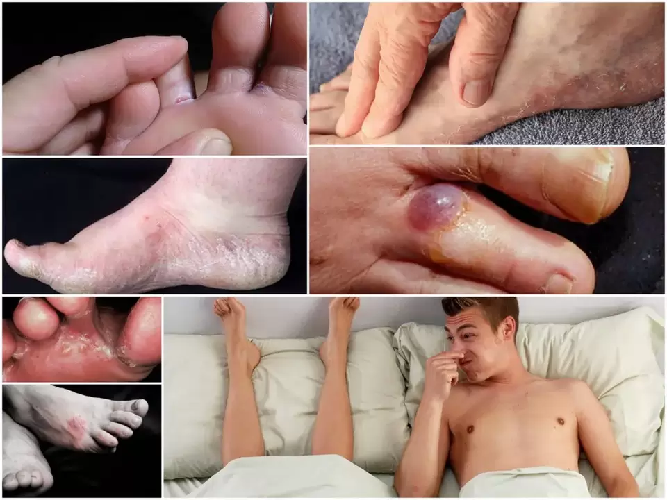 Key symptoms of foot fungus