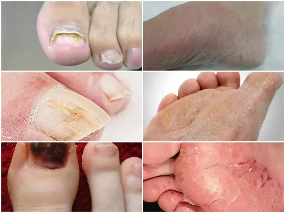 Manifestations of foot fungus caused by various pathogens