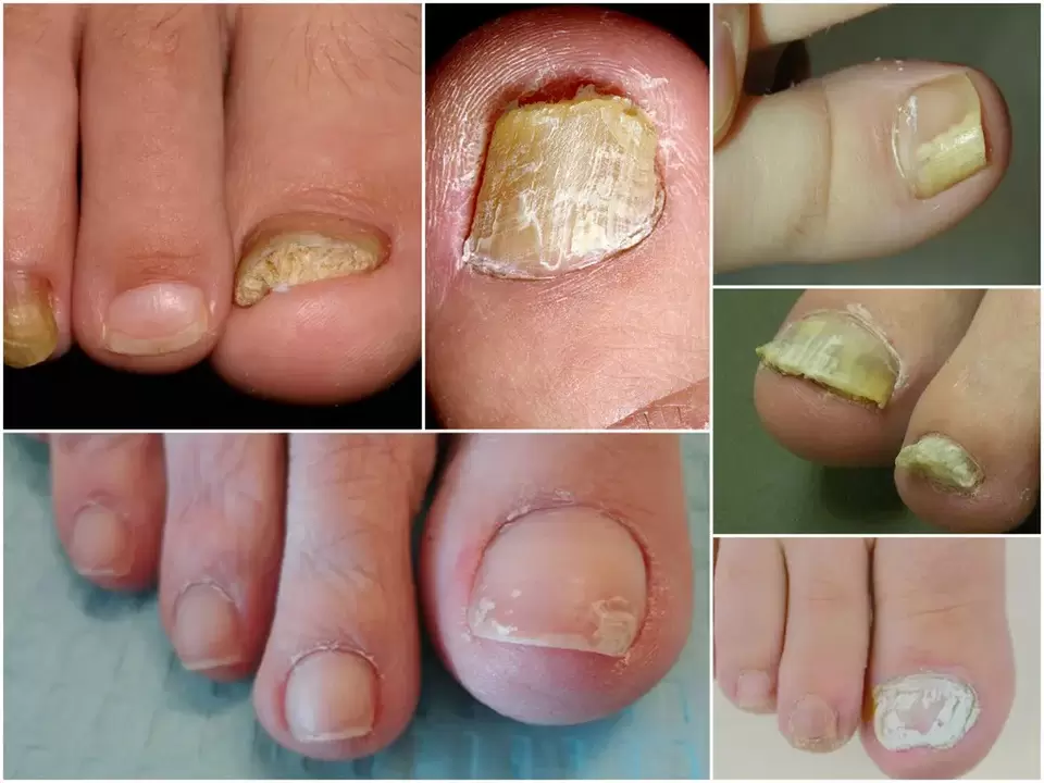 Symptoms of different forms of onychomycosis