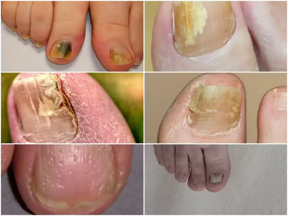 Symptoms of onychomycosis – changes in nail color and structure