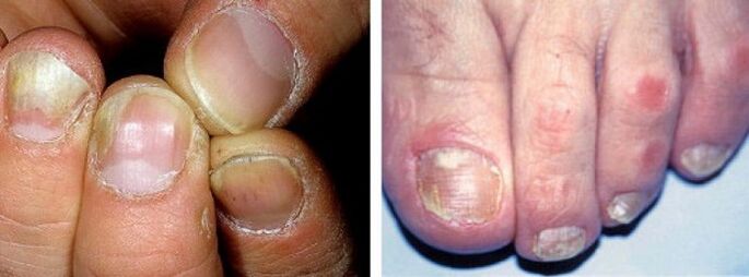 Manifestations of fungal infections on nails
