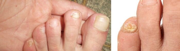 Photograph of toenail fungus manifestation