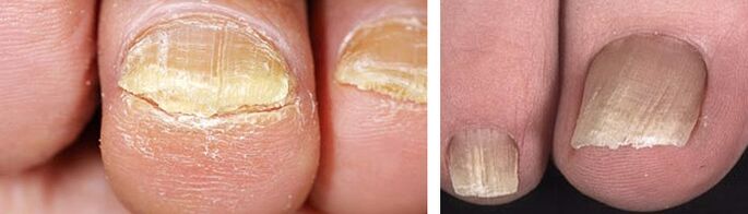 Nails damaged by fungal infections