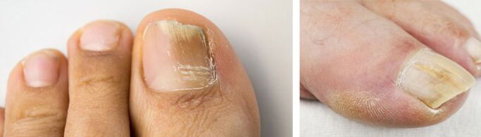 Photograph of a fungal infection on the nail of the big toe