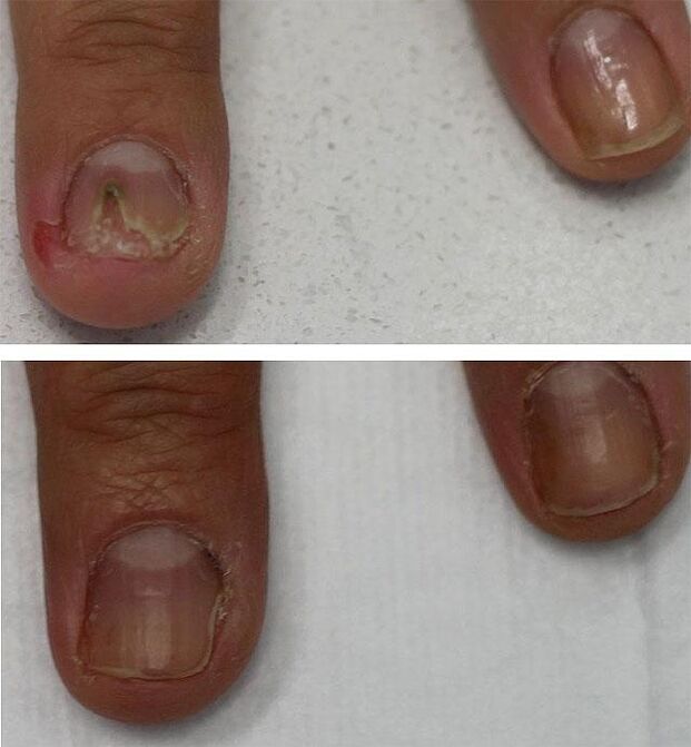 Fungal infection of toenails
