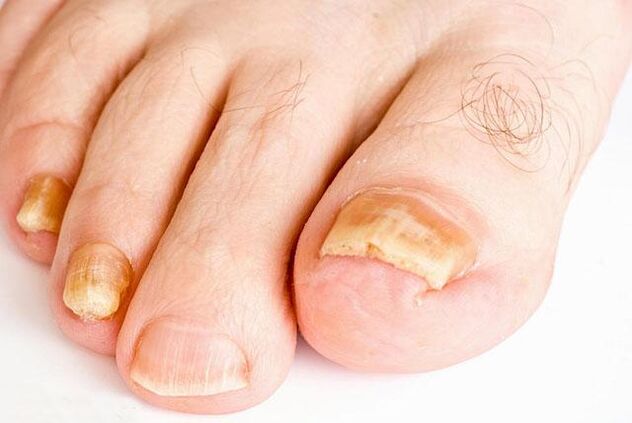What does toenail fungus look like