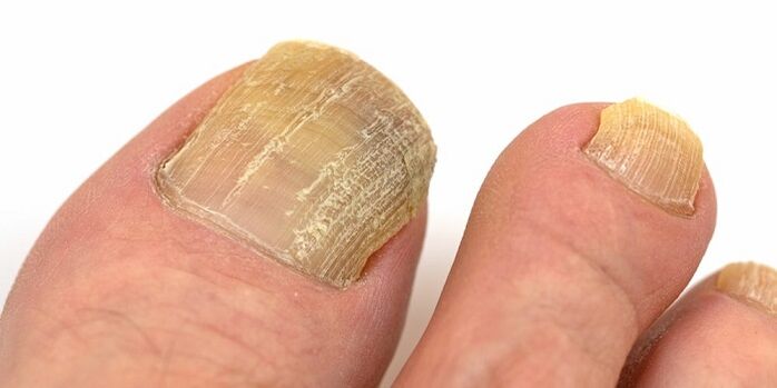 Damaged nails with fungal infection