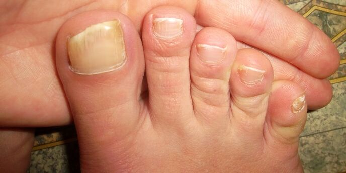 Fungus infests toenails