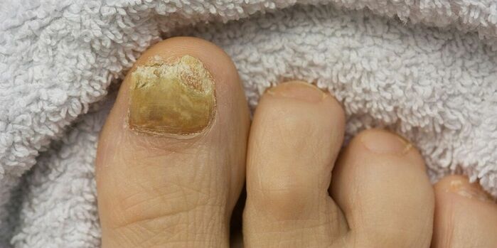 Yellow toenail fungus infection