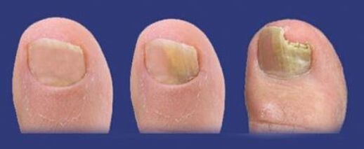 Developmental stages of toenail fungus