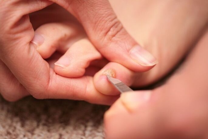 Anti-fungal nail treatment