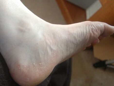 Peeling legs and feet are a sign of fungal infection