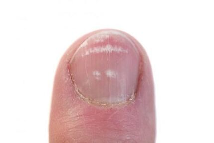 The initial stages of nail fungal infection