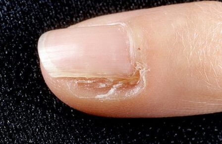 Use fungus to remove part of the nail